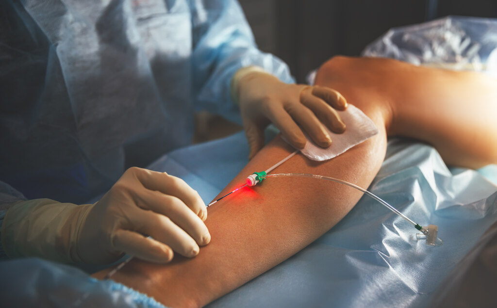 Close-up das mãos de um médico com luvas cirúrgicas realizando um procedimento vascular em um paciente. O profissional utiliza um cateter com luz de laser vermelha inserido na veia da perna. A foto representa procedimentos médicos modernos, como o laser e a escleroterapia, demonstrando clinicamente como tratar varizes.