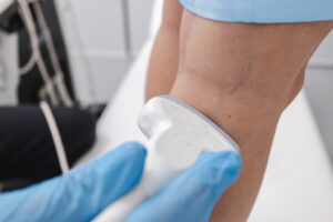 medico fazendo tratamento em perna com veia estourada