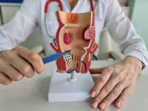 medico mostrando onde ocorre sangramento anal