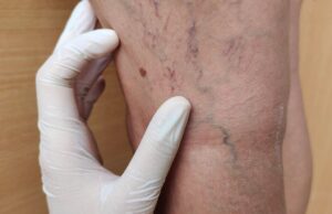 risco aplicação espuma em varizes