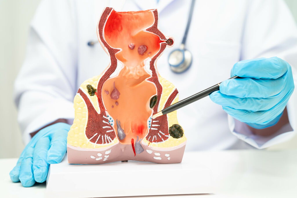 cirurgia cura hemorroida