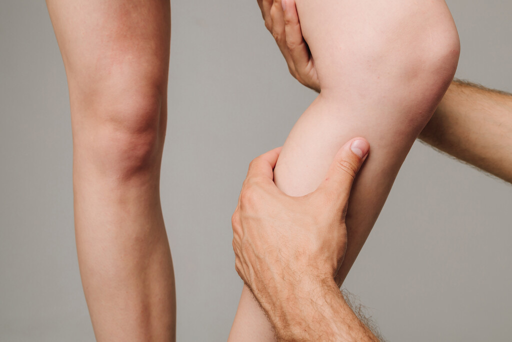 escleroterapia com glicose