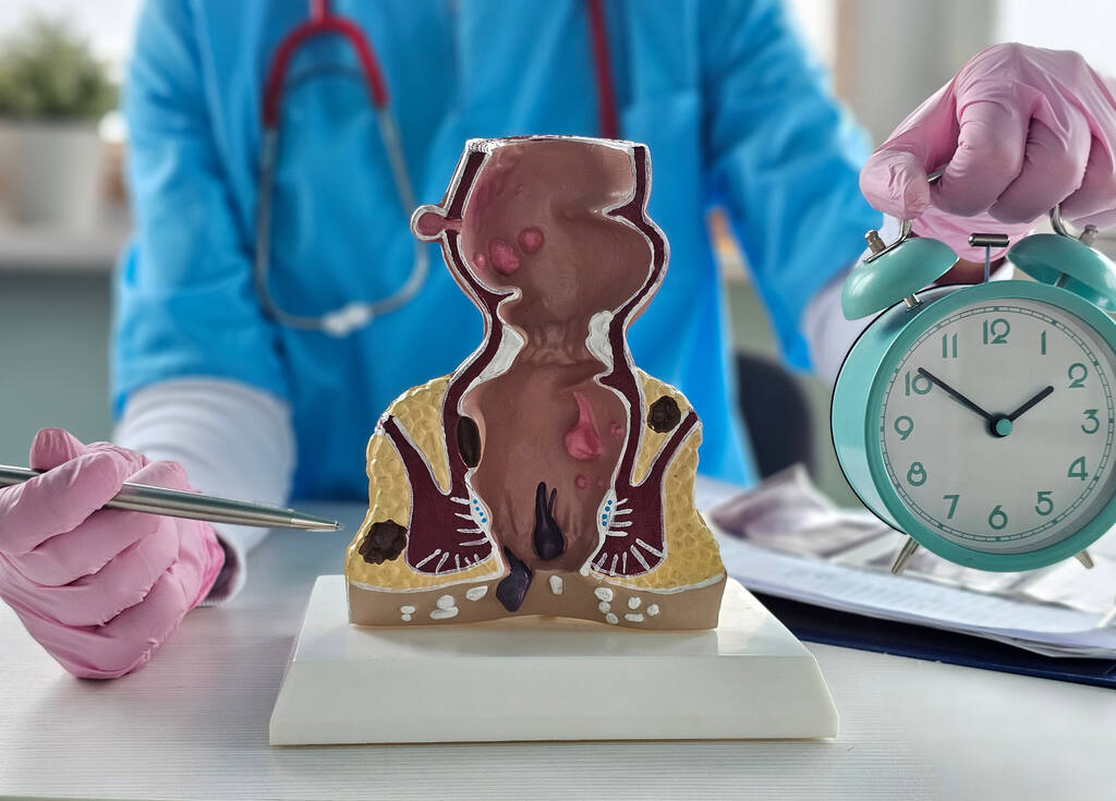 Médico apontando para um modelo anatômico do reto com hemorroidas ao lado de um relógio, ilustrando as causas e a importância do tratamento imediato.