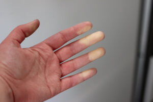 maos com ma circulação